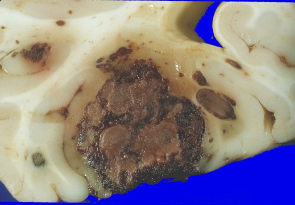 1A6 Leukemia, nodules AMML (Case 1) 3