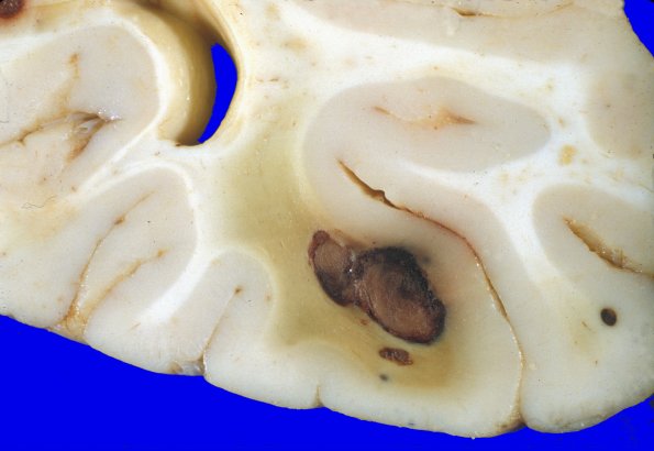 1A7 Leukemic Nodules (Case 1) b