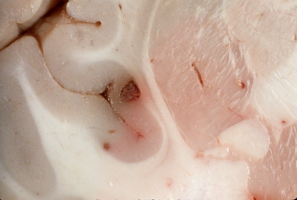 1A8 Leukemic nodules (Case 1) gross 2