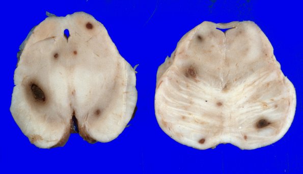 1C1 Leukemic nodules (Case 1) gross 1