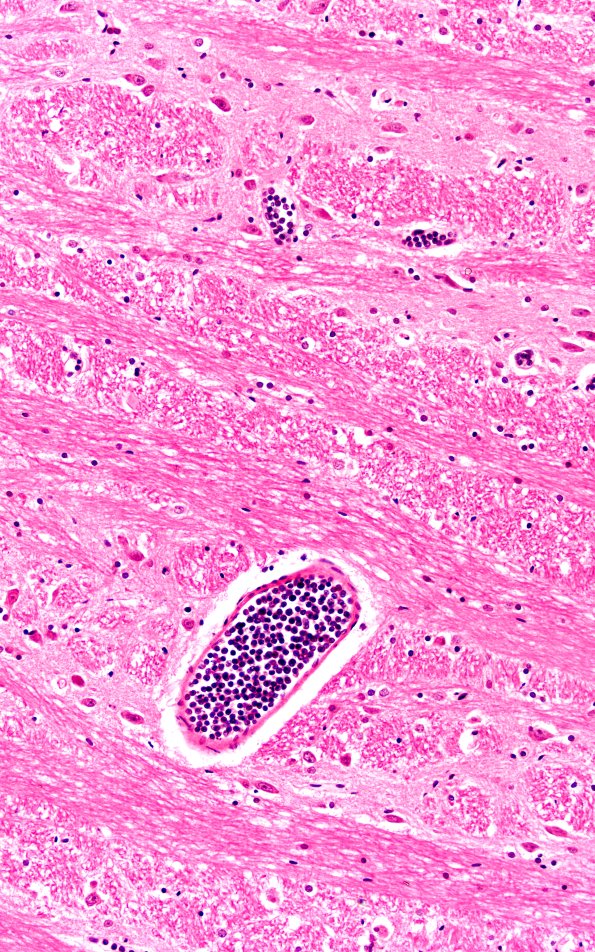 1C3B (Case 1) A 20X 2A