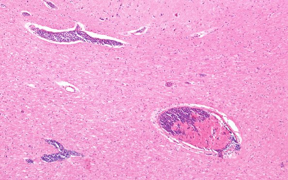 1C4 (Case 1) B 10X 2