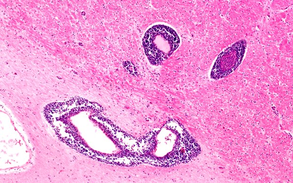 1C5 (Case 1) D 10X 1