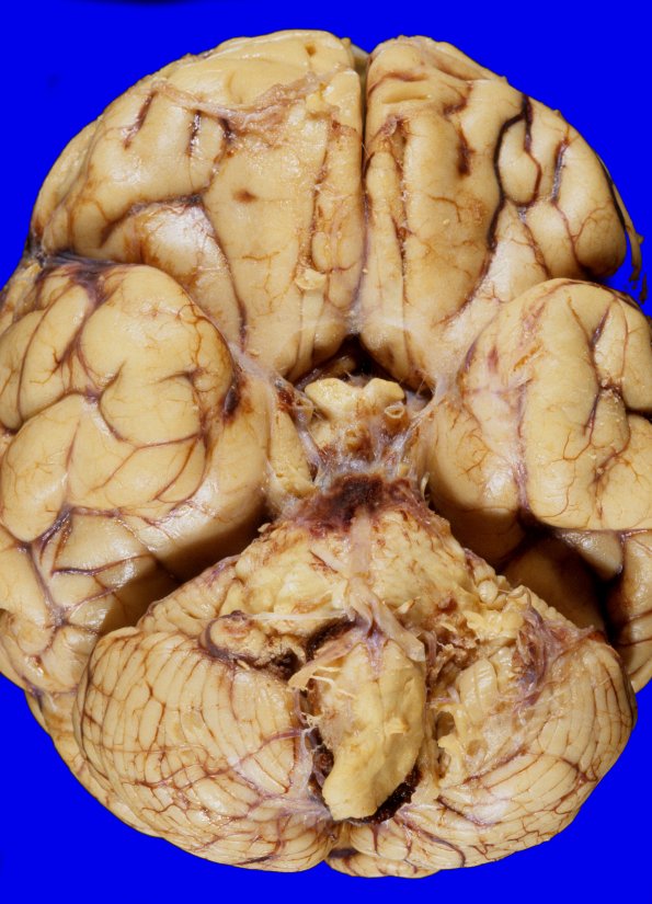 2A1 Hemorrhage (Case 2) 4