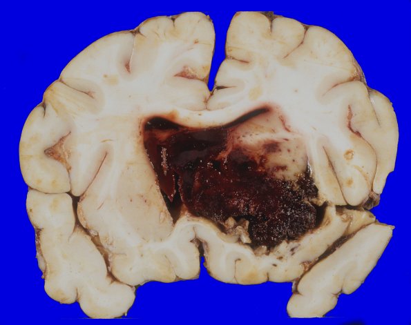 2A2 Hemorrhage (Case 2) 8