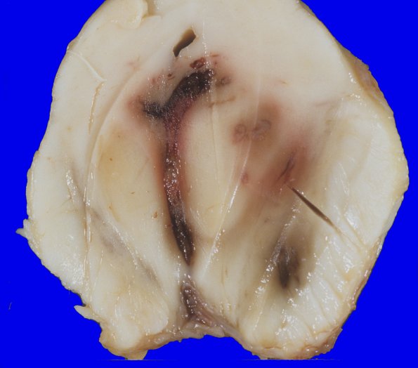 2A4 Hemorrhage (Case 2) 6