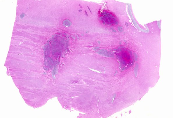 2B1 Leukemia (Case 2) N1 WM