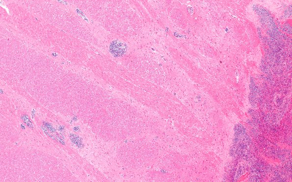 2B2 Hemorrhage (Case 2) 4X