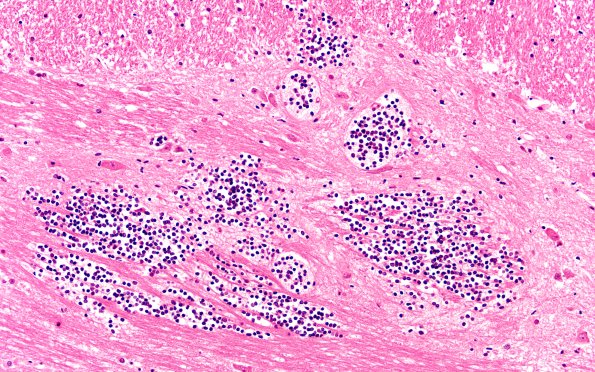 2B3 Hemorrhage (Case 2) 20X