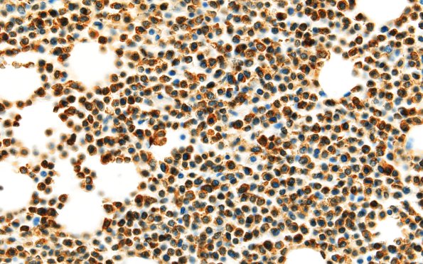 2CHemorrhage (Case 2) MPO 60X marrow MPX