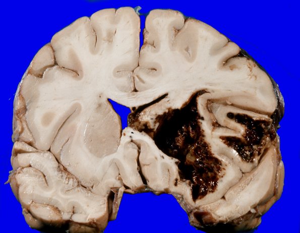 3A1 Leukemic nodules (Case 3) gross 2