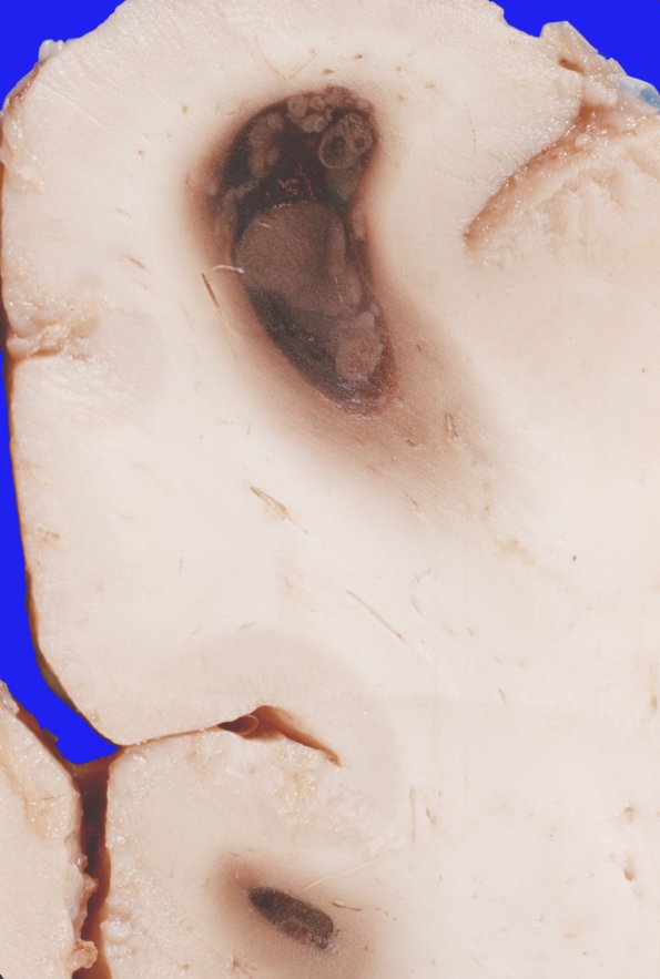 3A2 Leukemic nodules (Case 3) gross 1A