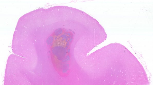 3B1 Leukemic Nodules (Case 3) WM