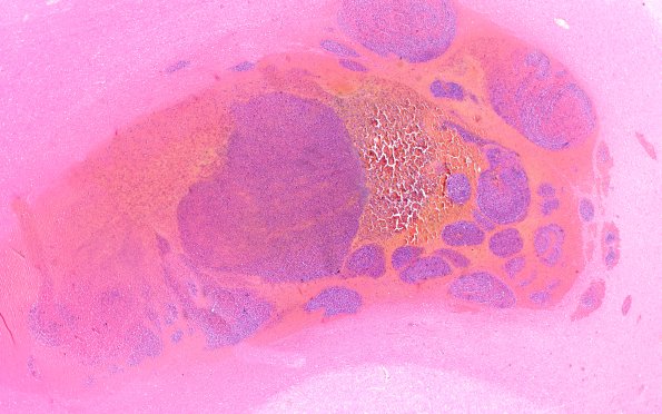 3B2 Leukemic Nodules (Case 3) 2X 1