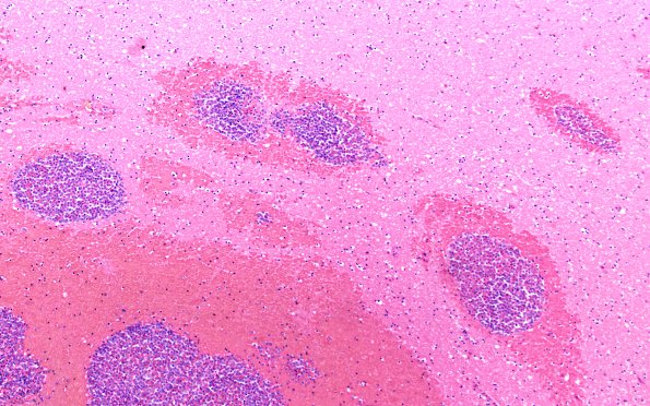 3B3 Leukemic Nodules (Case 3) 10X 1
