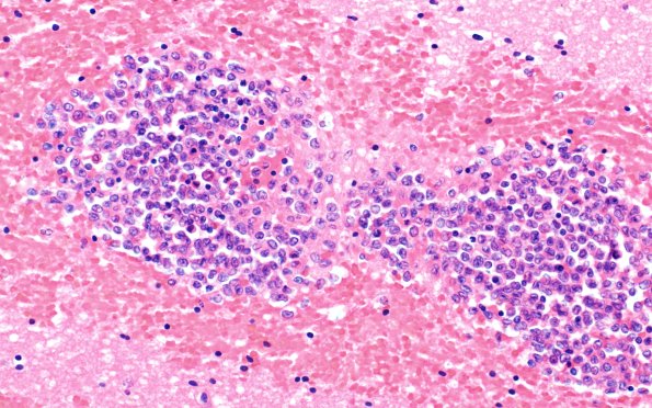 3B4 Leukemic Nodules (Case 3) 40X 1