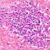 3B5 Leukemic Nodules (Case 3) 60X 1