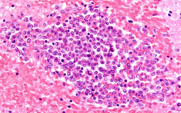 3B5 Leukemic Nodules (Case 3) 60X 1