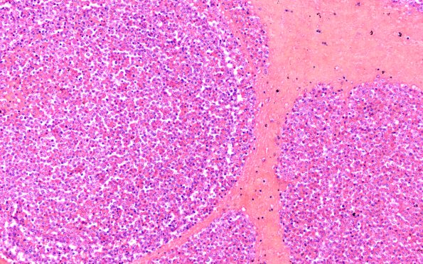 3B6 Leukemic Nodules (Case 3) D 20X