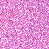 3B7 Leukemic Nodules (Case 3) D 40X