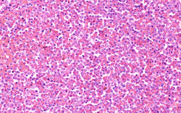 3B7 Leukemic Nodules (Case 3) D 40X