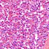 3B8 Leukemic Nodules (Case 3) D 60X