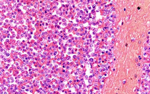 3B8 Leukemic Nodules (Case 3) D 60X