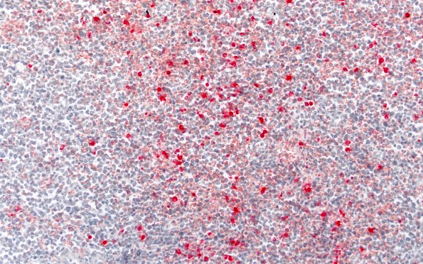 3C1 Leukemic Nodules (Case 3) Leder 20X