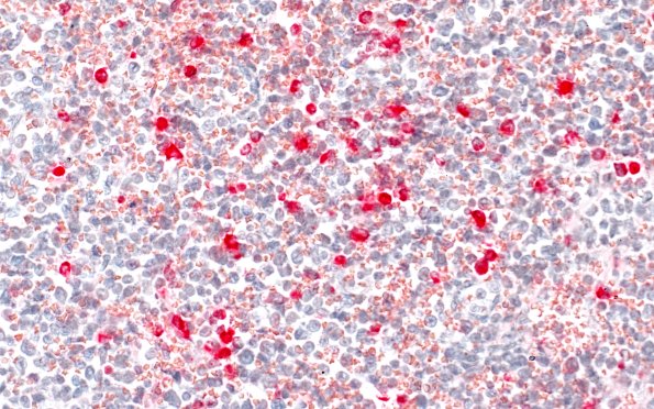 3C2 Leukemic Nodules (Case 3) Leder 40X