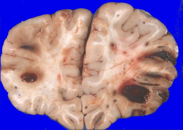 4A1 Leukemic nodules (Case 4) gross 3