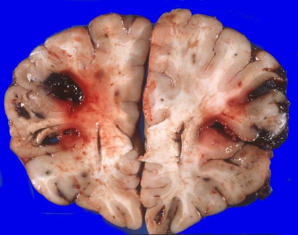 4A2 Leukemic nodules (Case 4) gross 8