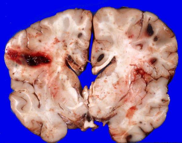 4A3 Leukemic nodules (Case 4) gross 7