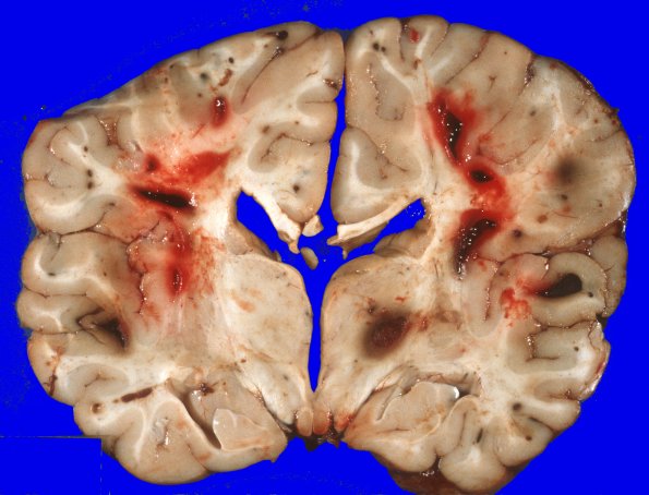 4A4 Leukemic nodules (Case 4) gross 5
