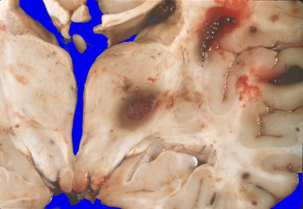 4A5 Leukemic nodules (Case 4) gross 6