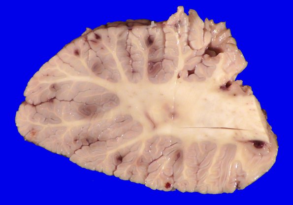 5A2 Leukemic nodules (Case 5) Gross_9