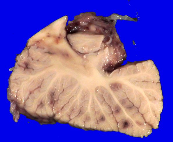 5A3A Leukemic nodules (Case 5) Gross_2