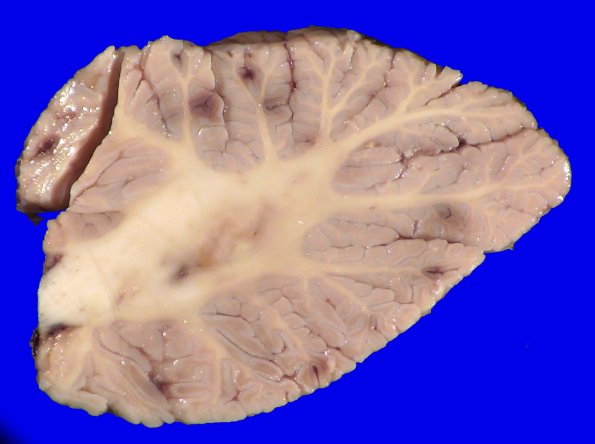 5A4A Leukemic nodules (Case 5) Gross_5