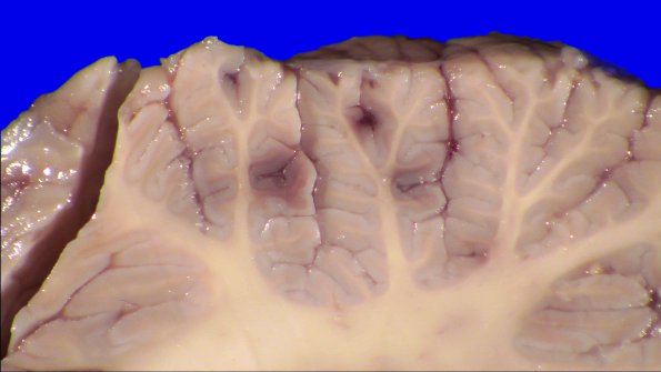 5A4B Leukemic nodules (Case 5) Gross_7