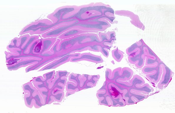 5B1A Leukemic nodules (Case 5) N13 WM