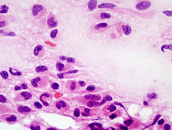 10B LCH (Case 10) H&E smear 100X.jpg