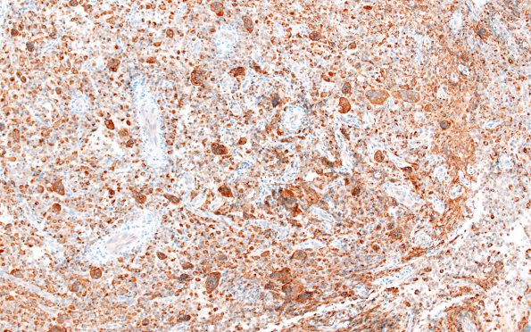 12C LCH (Case 12) CD68 1