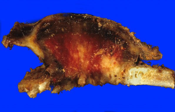 14A2 LCH, Eosinophilic Granuloma (Case 14) 1