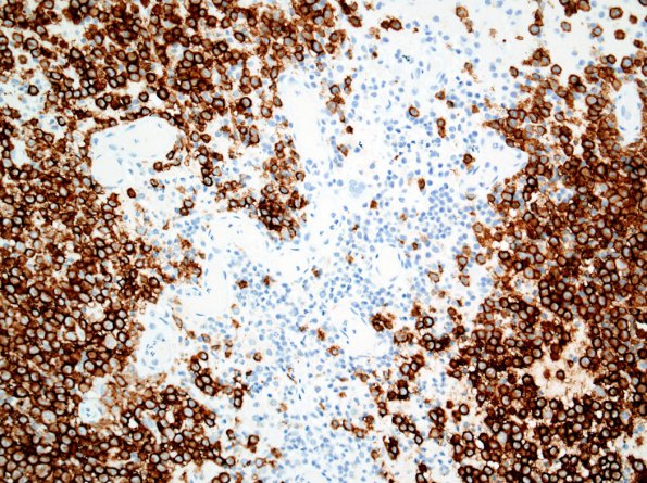 14C1 LCH (Case 14) CD1a 1.jpg