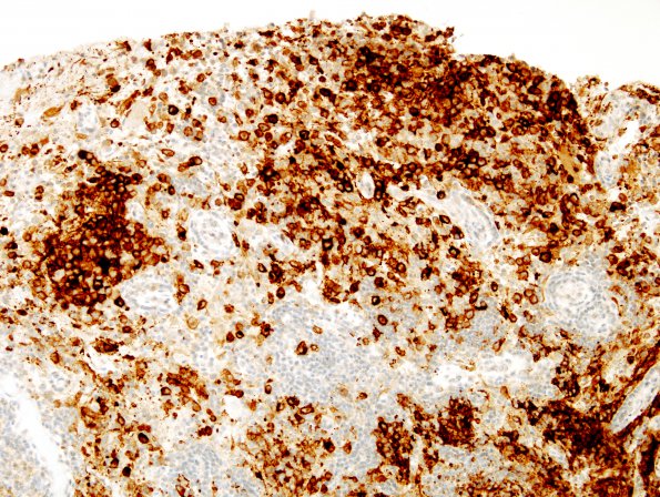 16C1 LCH (Case 16) CD1a  1