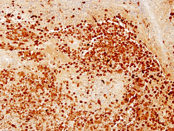 17C LCH (Case 17) S-100 1