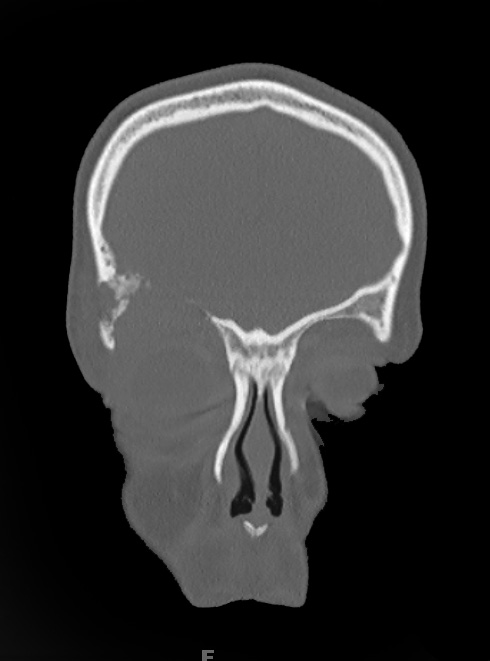 19A2 LCH (Case 19) CT 2 - Copy