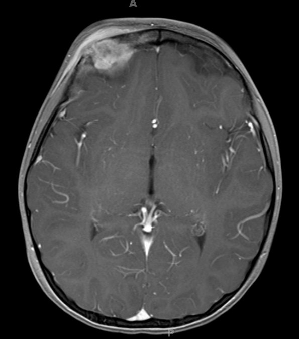 19A5 LCH (Case 19) T1W 1 - Copy