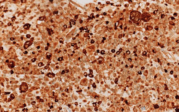 19C LCH Case 19) CD68 40X 2