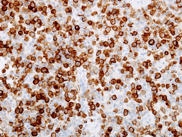 1C2 LCH (Case 1) CD1a 1