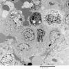 1F1 Langerhan's Cell Histiocytosis (Case 1) EM 007 - Copy